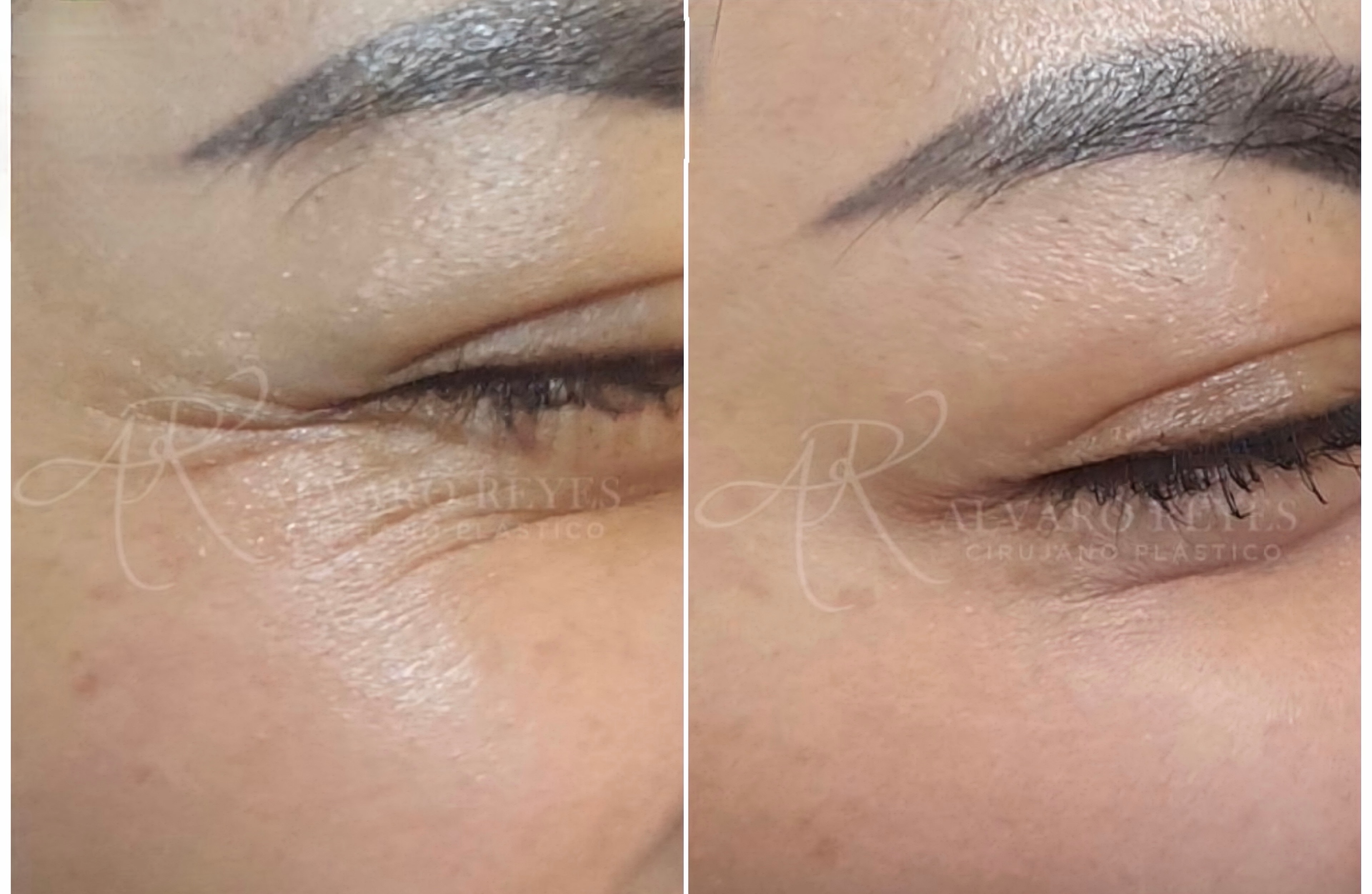 BOTOX