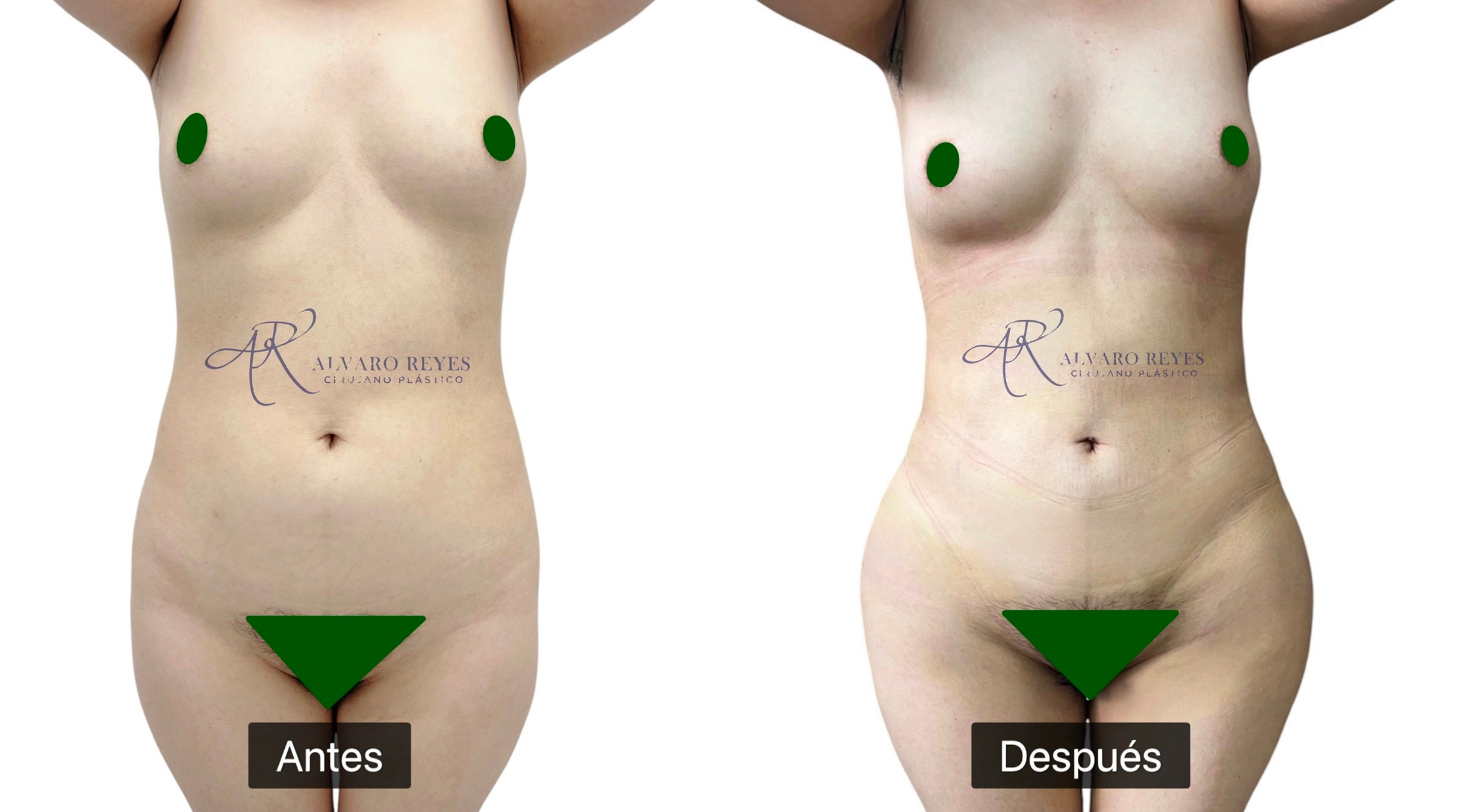 Lipoescultura 360°