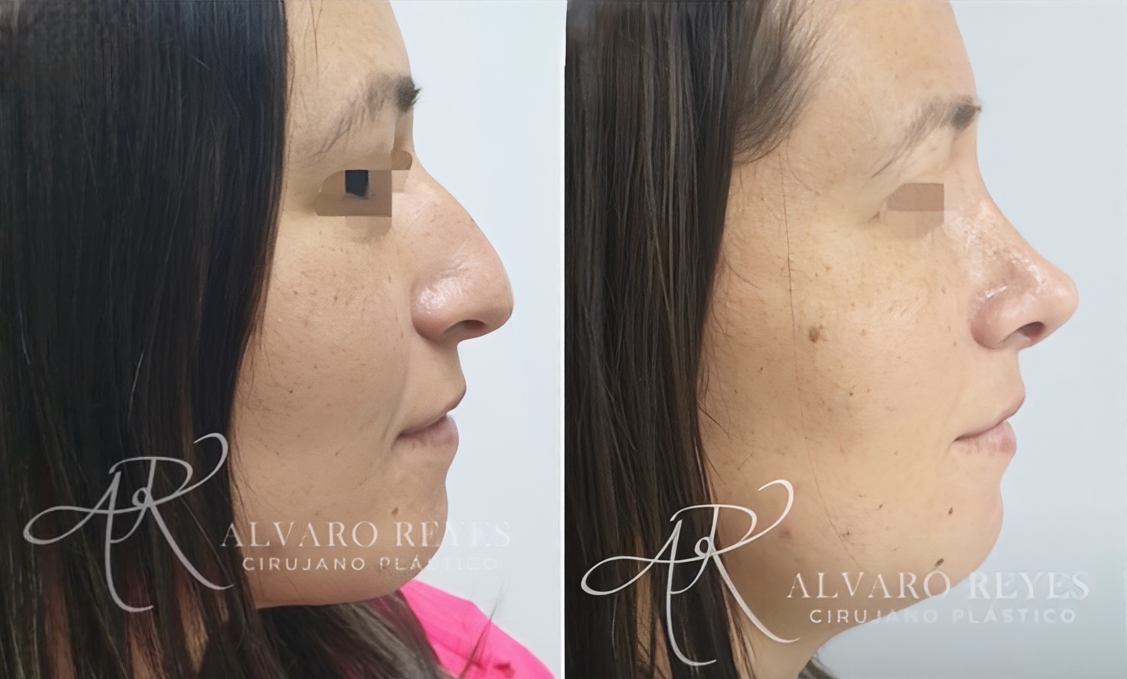 Rinoplastia