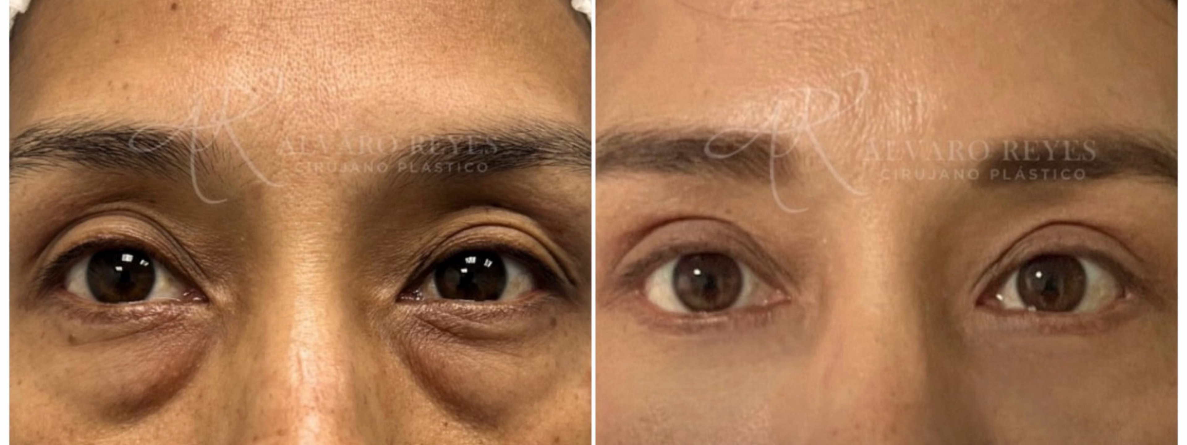 Blefaroplastia